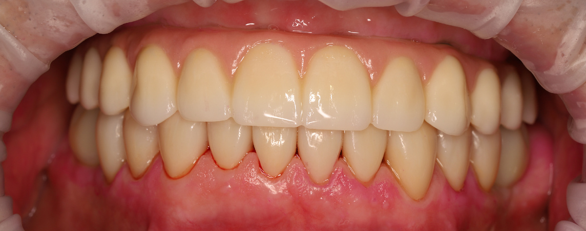 Пациент клиники ПРАЙМ после установки виниров на нижней челюсти (10 единиц + 2 коронки на имплантате). На верхней челюсти установлена система "всё-на-четырёх". 