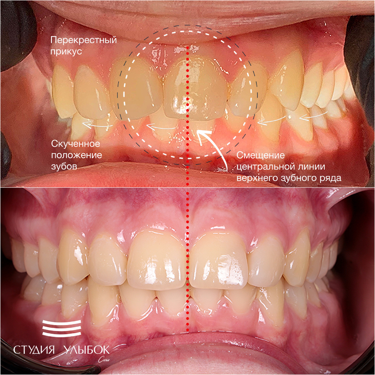 Несовпадение центральной линии зубов верхней и нижней челюстей