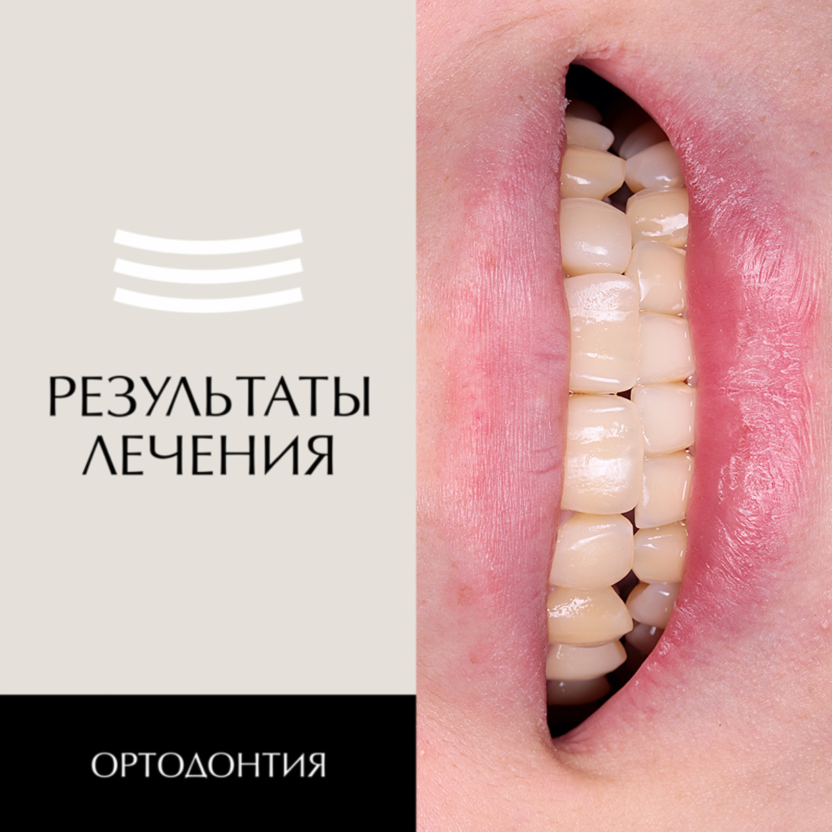 Кейс по ортодонтическому лечению