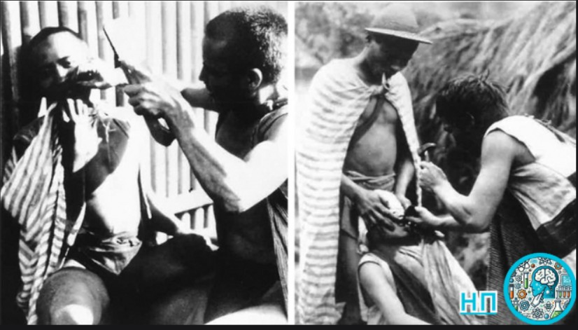 Удаление зубов с помощью тяпки и молотка.