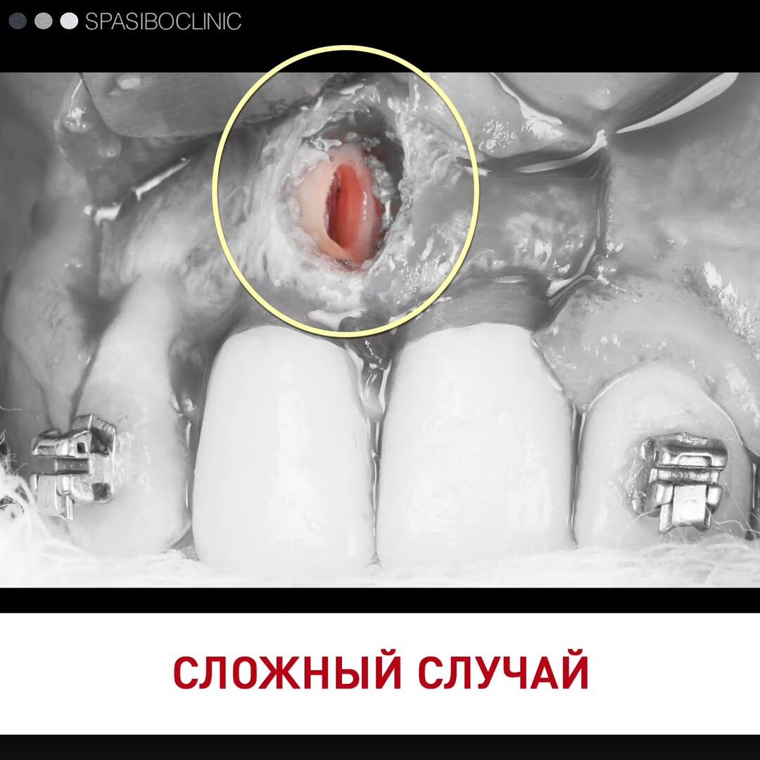 
Удалять? Пациентке 26 лет, зуб передний.

Решение есть⬆️
⠀
🦷Работа закончена 1,5 года назад, результат стабилен.
⠀
⚙️Хирургия, пародонтология — Алексеи‌ Фролов @dr.alexey.frolov