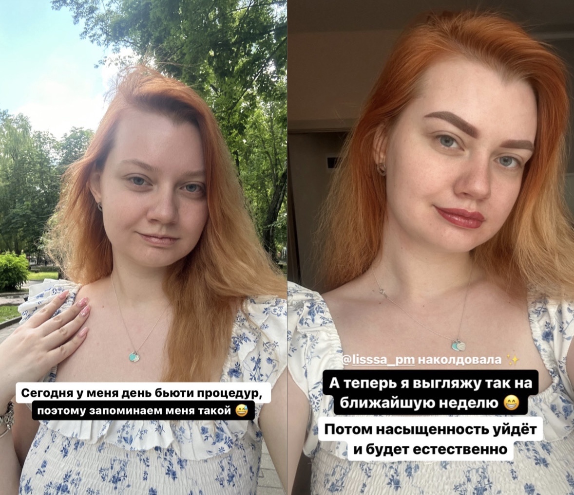 Я без макияжа и сразу после процедуры