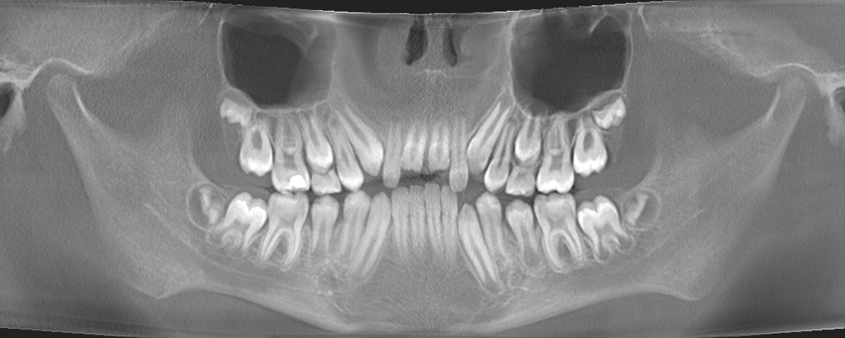 Надеюсь это не шок-контент? Это зубы старшего сына.