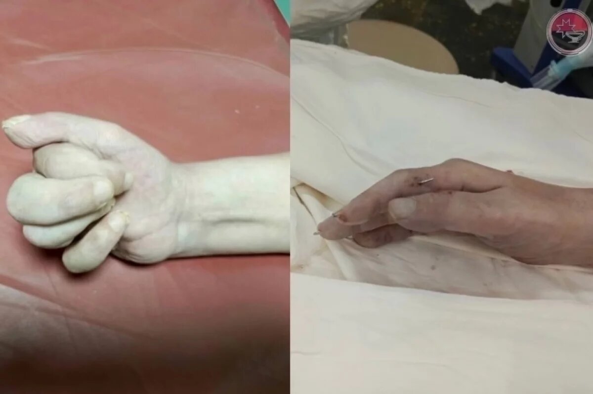    Бойцу СВО из Удмуртии, пережившему минно-взрывное ранение, провели операцию