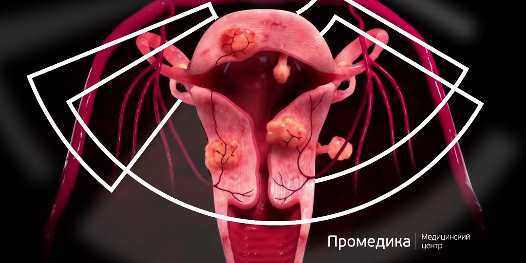 Миома матки. Важные факты, которые каждая женщина должна знать