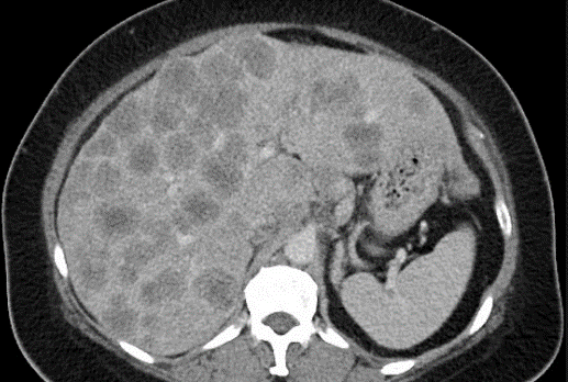 Вид метастазов в печени при проведении компьютерной томографии. 