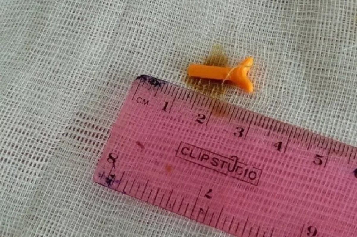    Жительница Кузбасса 20 лет ходила с деталью от конструктора в ухе