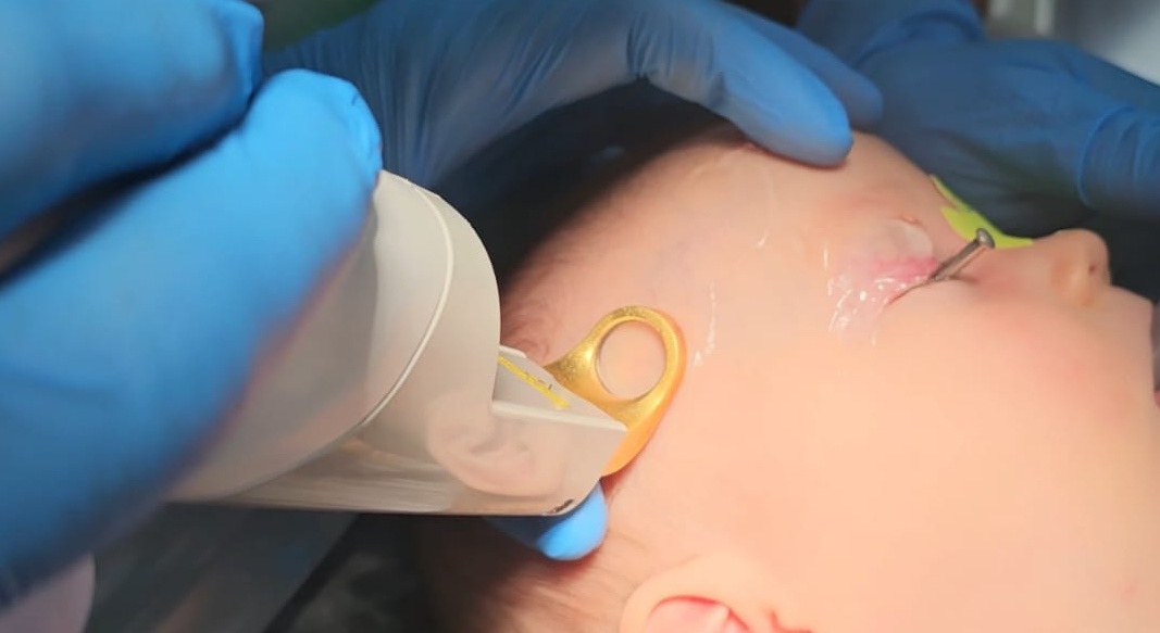 Обработка лазером при установленной защитной шильде.