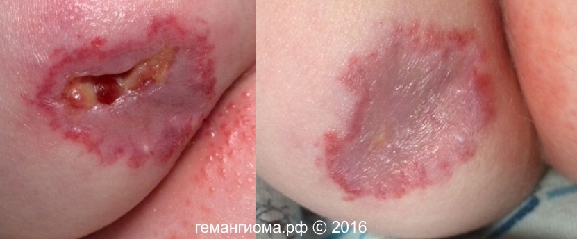 Результаты применения геля через 7 дней. Младенческая гемангиома в ягодичной области.