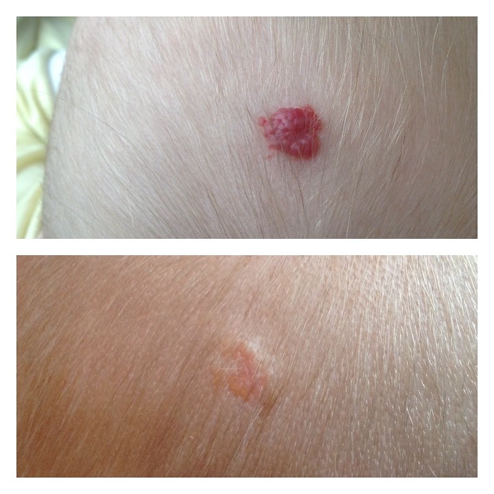 Младенческая гемангиома до лечения и после курса местной терапии каплями Арутимол 0,5%