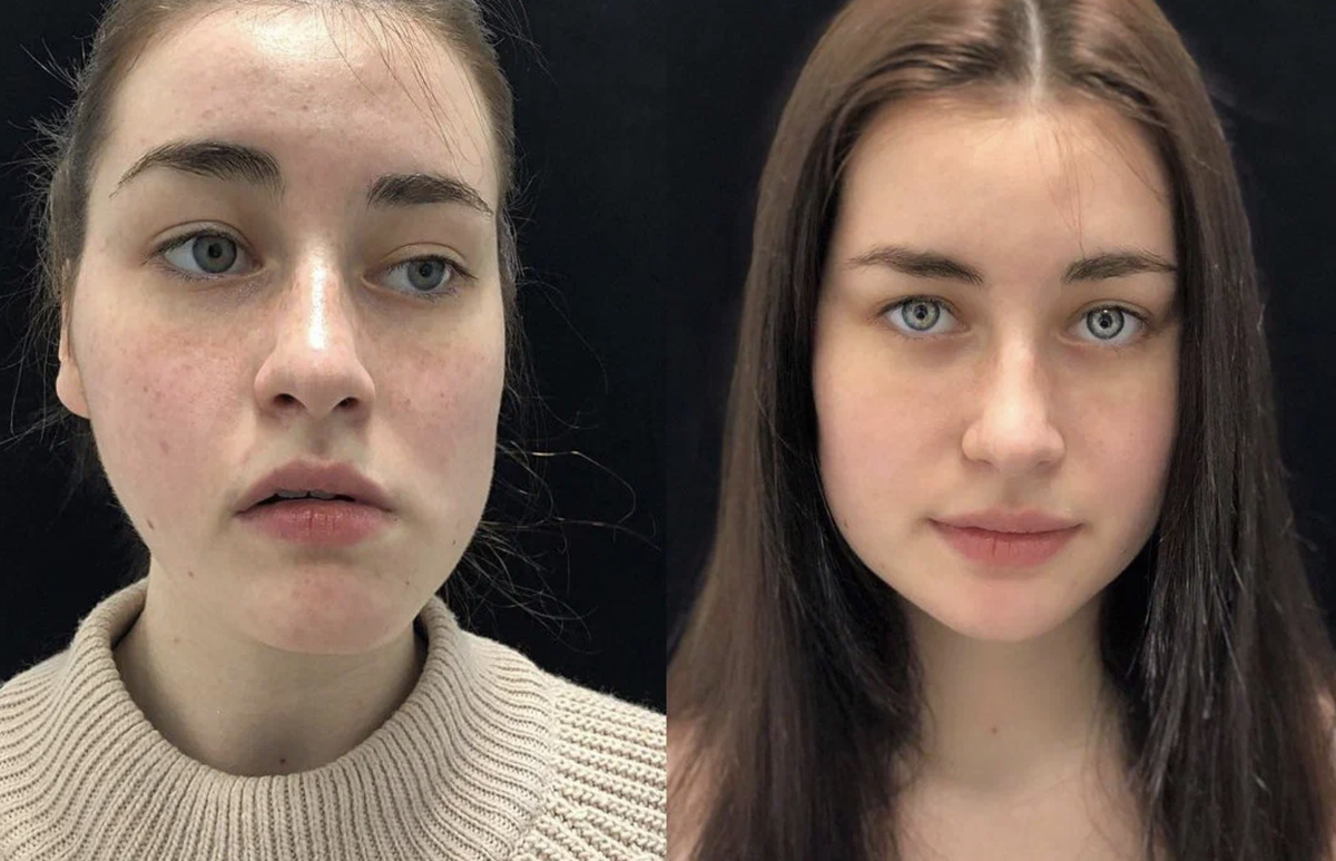 Результат лечения в Международной Сети Медицинских Центров "Симметрия"