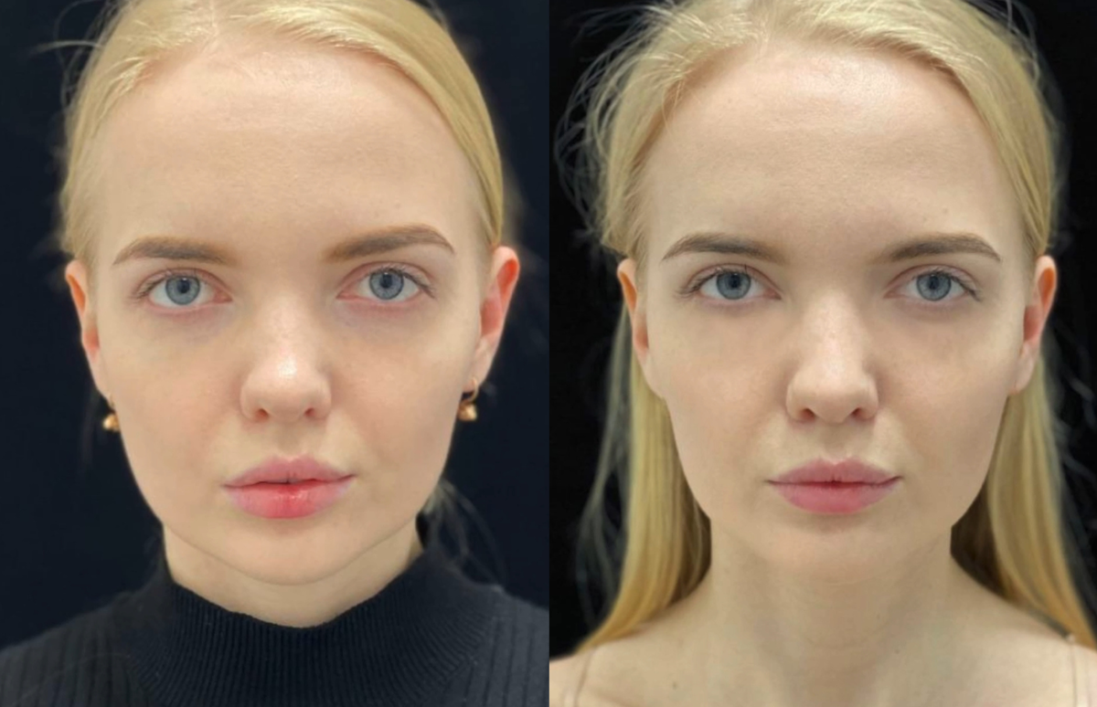 Результат лечения в Международной Сети Медицинских Центров "Симметрия"