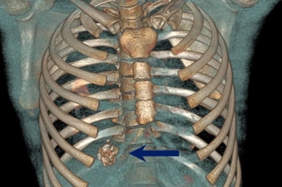    Подростка с разорвавшейся в груди петардой спасли иркутские врачи