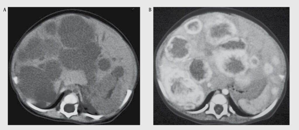 Компьютерная томография с контрастированием органов брюшной полости. На снимках определяются множественные патологические очаги в паренхиме печени. Изображение из книги Vascular anomalies. Mulliken and Young’s.