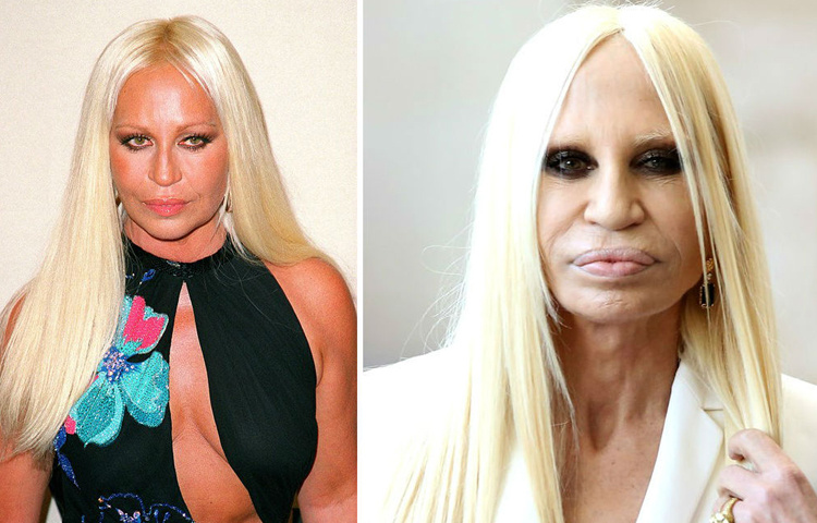 Донателла Версаче – классический пример жертвы косметологии и пластической хирургии