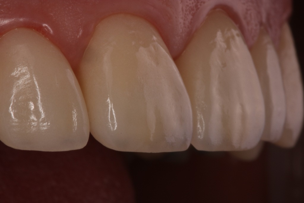 Современные материалы настолько прочные и эстетичные, что необходима минимальная обработка тканей зуба. 