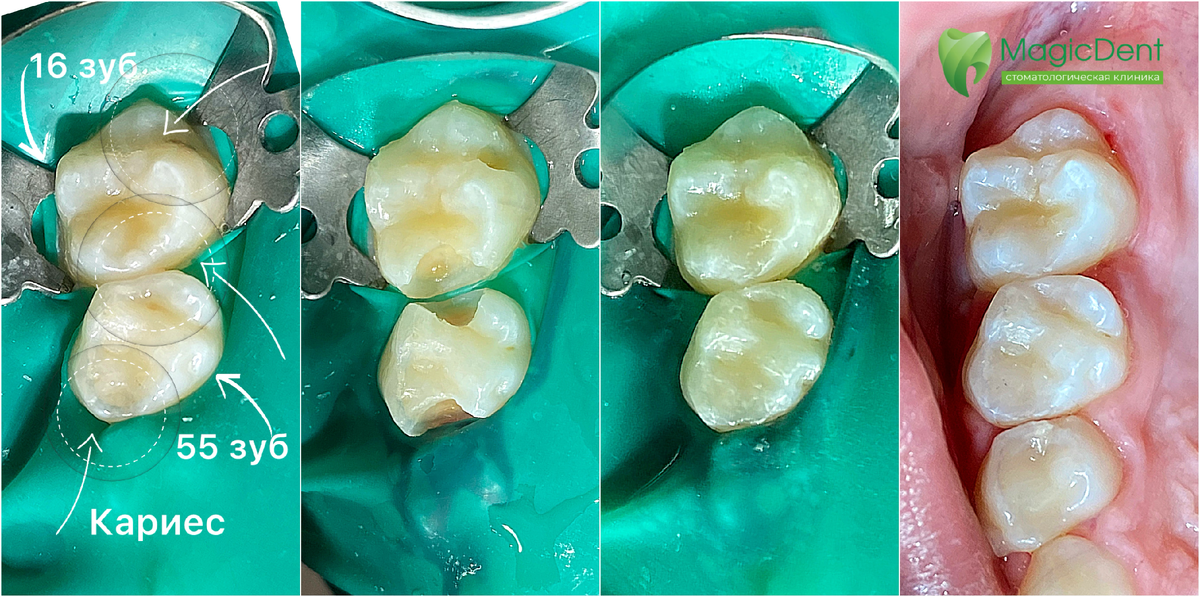 Лечение скрытого кариеса постоянного 16 зуба и молочного 55 зуба у ребенка