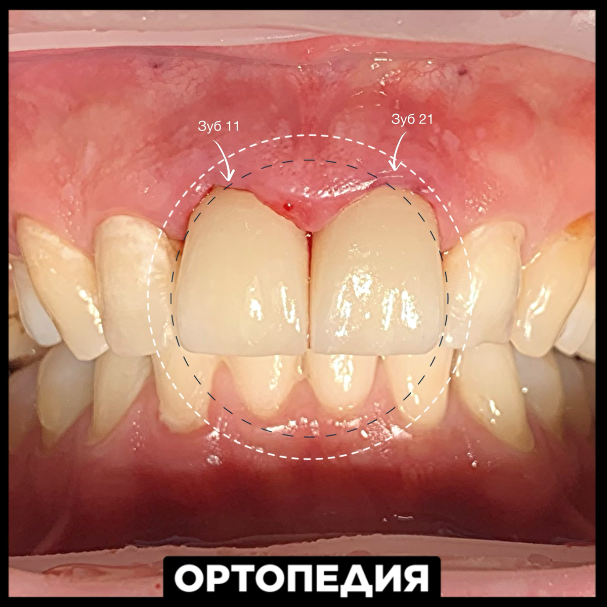 Коронки E.Max - высокой эстетики. Выглядят, как свои зубы.