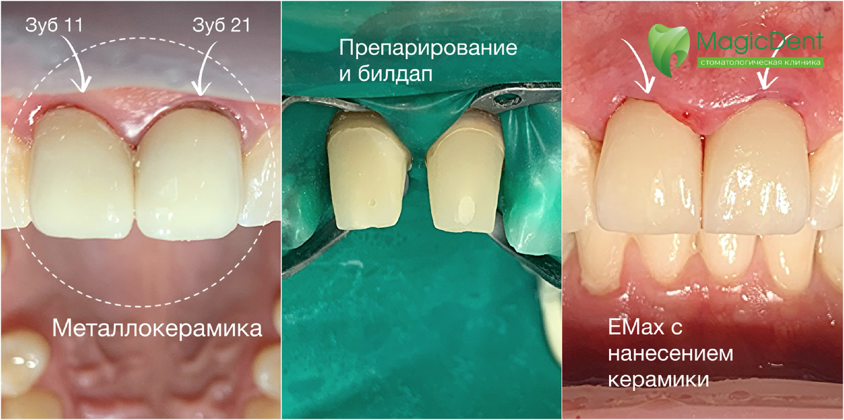 Замена металлокерамических коронок на выскоэстетичные коронки E.Max