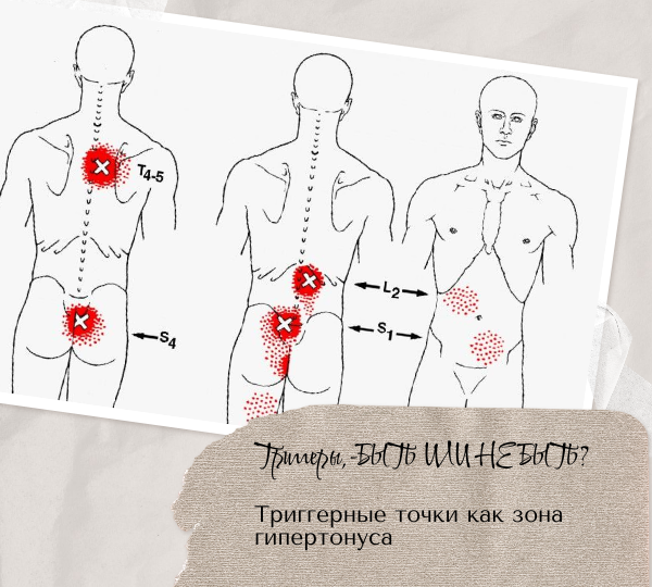 Триггеры. Точки на теле, которые болят, - и что с ними делать?