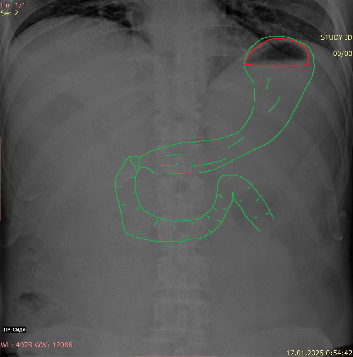 Красным выделен газовый пузырь желудка