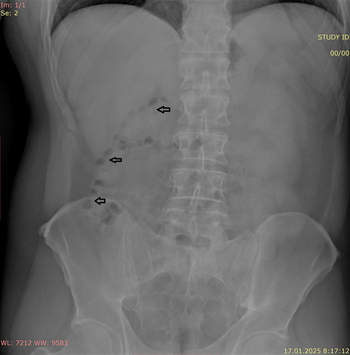 Газы в кишке