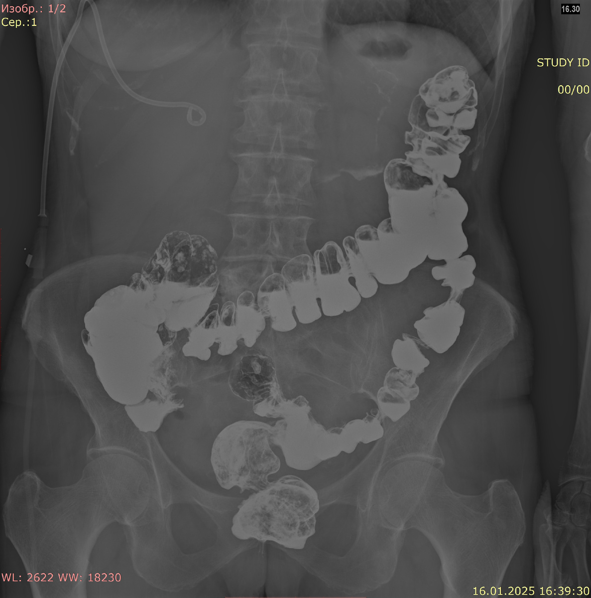 Толстая кишка (контраст с барием)