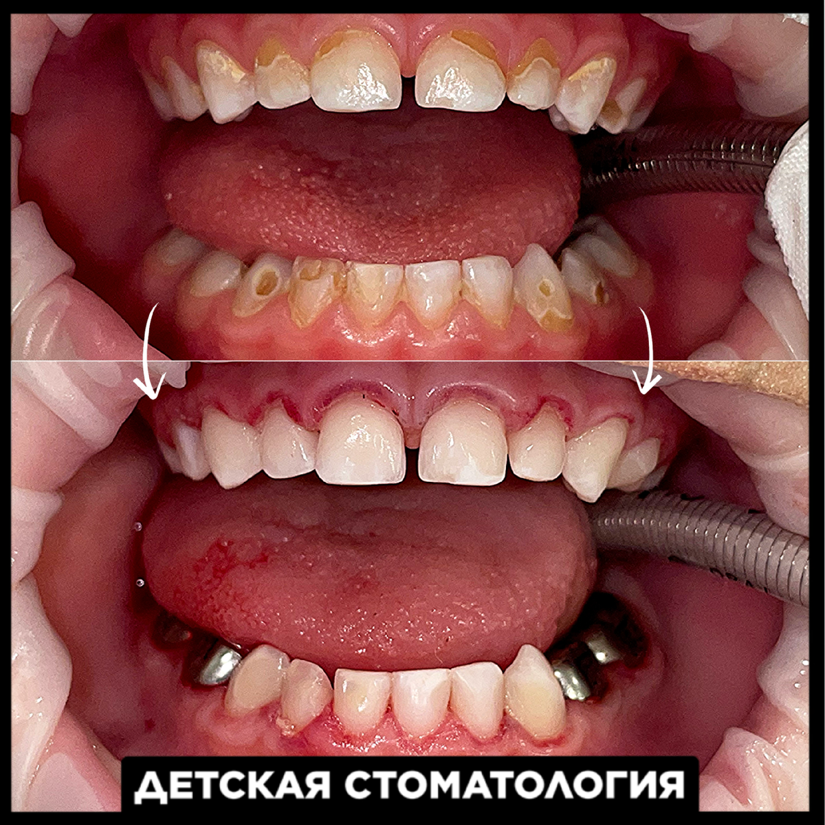 Стоматологическое лечение ребенка 4-х лет под наркозом