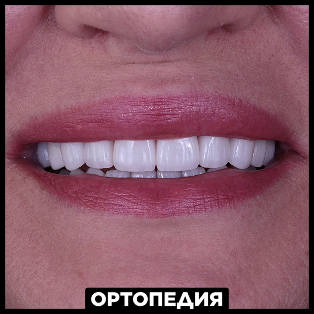 Виниры и коронки E.Max. Цвет Bleach 2