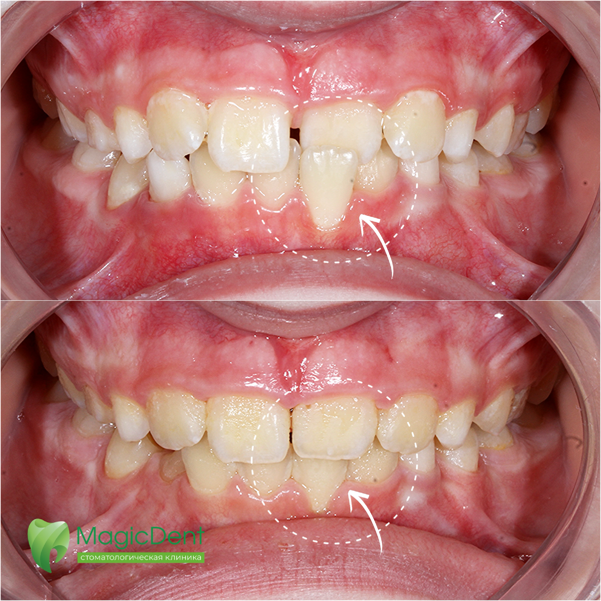 В данном случае для устранения аномалии положения зубов была назначена капа (трейнер)