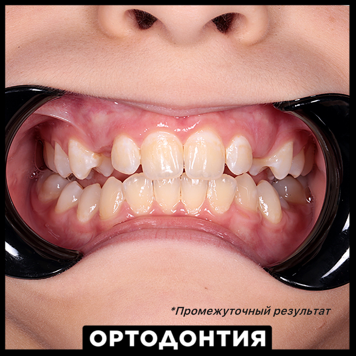 Результаты детской ортодонтии у ребенка 10-ти лет