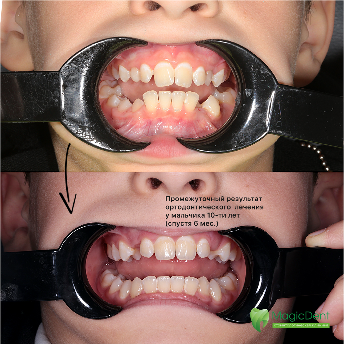 Выбран план лечения: съемный аппарат на верхней челюсти