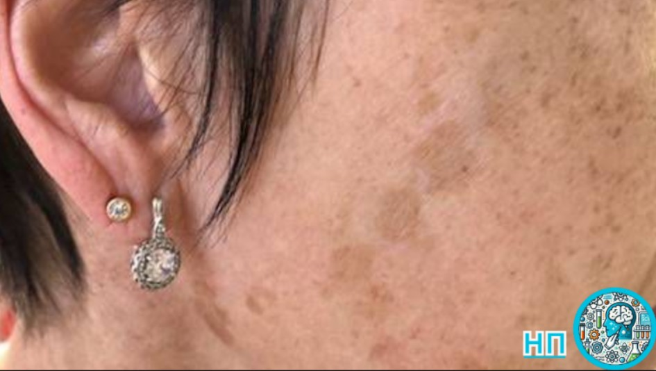 Пятна лентиго на лице