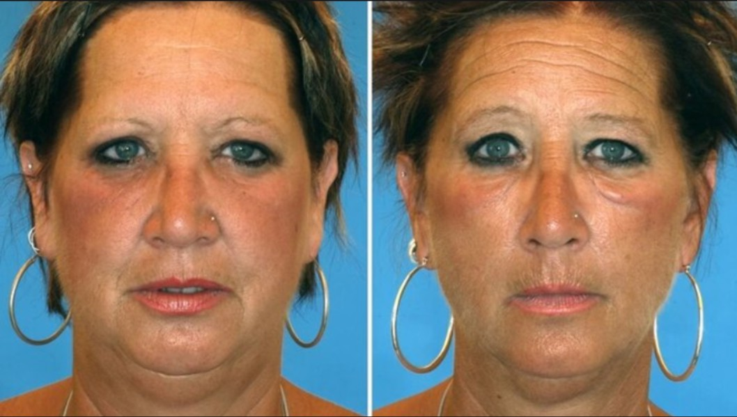 Однояйцевые близнецы спустя десятилетия.