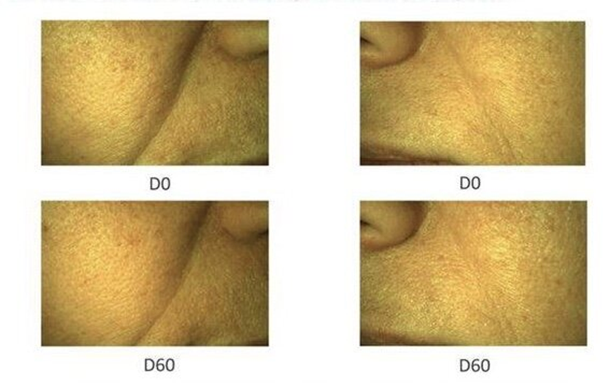 Пример до и после применения средства с адипофиллином. 