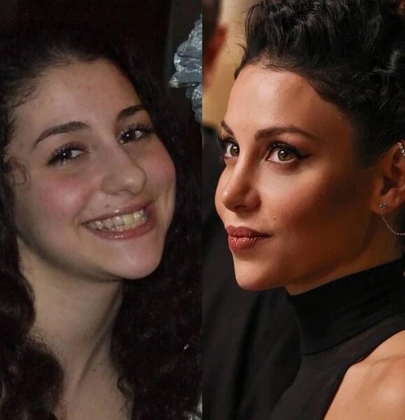    Зепюр Брутян до и после пластики, фото: .woman.ru