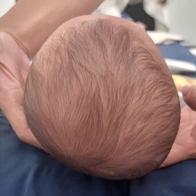 Плагиоцефалия