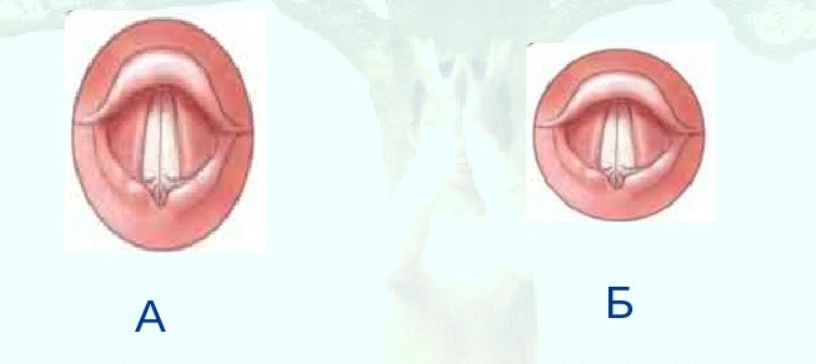 А- голосовые связки взрослого человека                         Б- голосовые связки детей