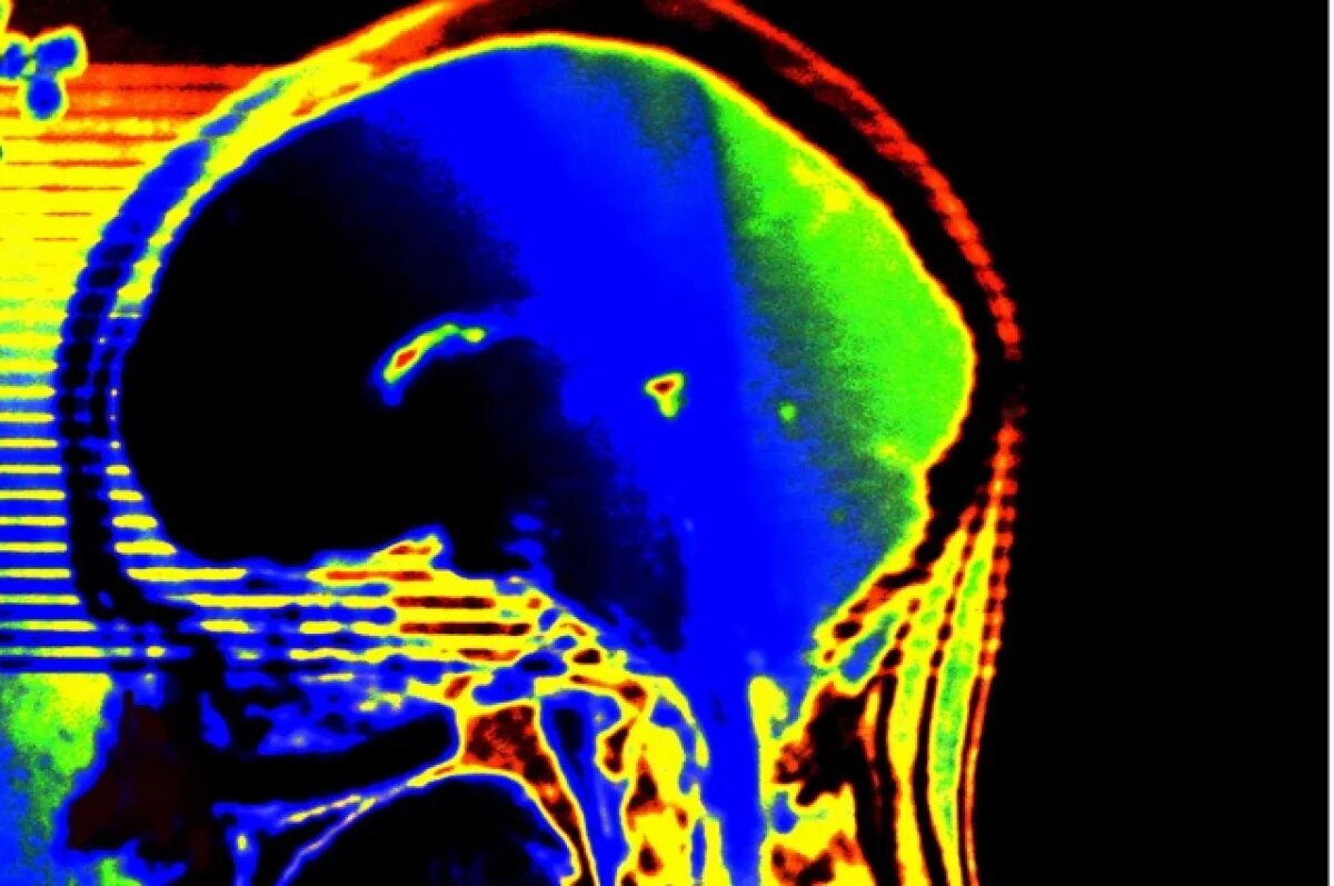    Врачи спасли жизнь 17-летней оренбурженке с менингитом