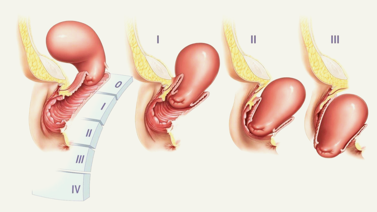 Опущение органов малого таза (фото из открытых источников)