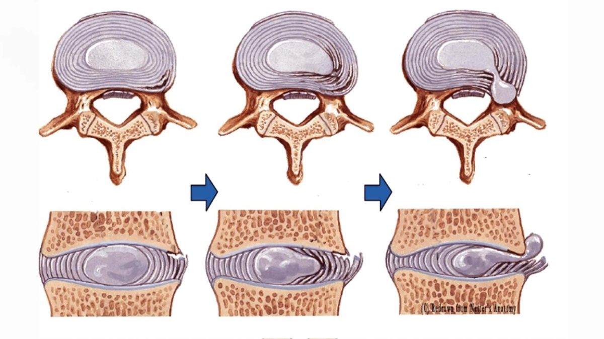 Как формируется грыжа в позвоночнике. Не пренебрегайте техникой выполнения упражнений