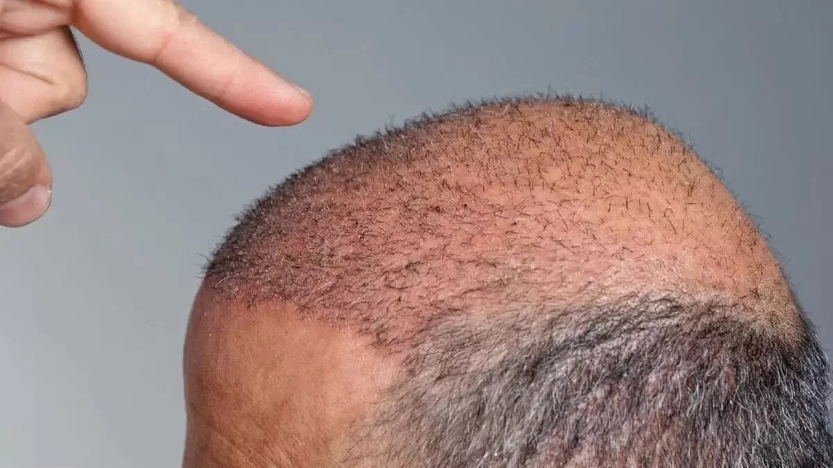 Шоковое выпадение волос после пересадке