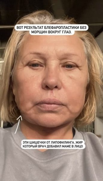    Мама Виктории Бони спустя год после пластики, фото: соцсети