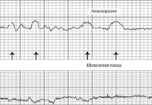 Акцелерации обозначены стрелками.