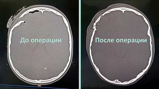    Перелом черепа, ушиб головного мозга и кровоизлияние. Кировские врачи спасли ребёнка после ДТП