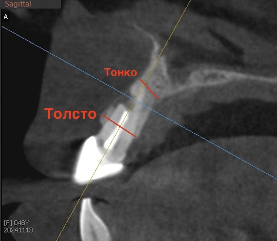 В тонкой части всего 4 мм