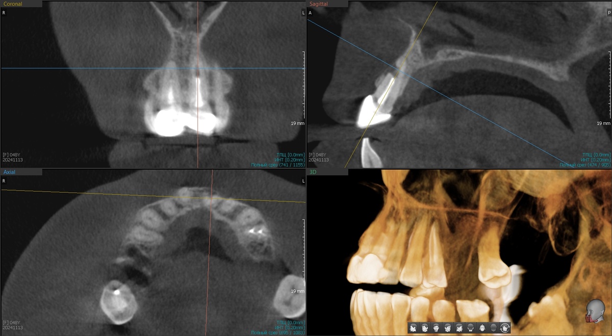 Дефект 2.1 зуба - резорбция корня