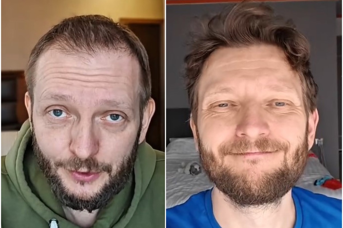     Резидент Comedy Club и участник шоу «Звезды в Африке» Константин Маласаев показал результат пересадки волос