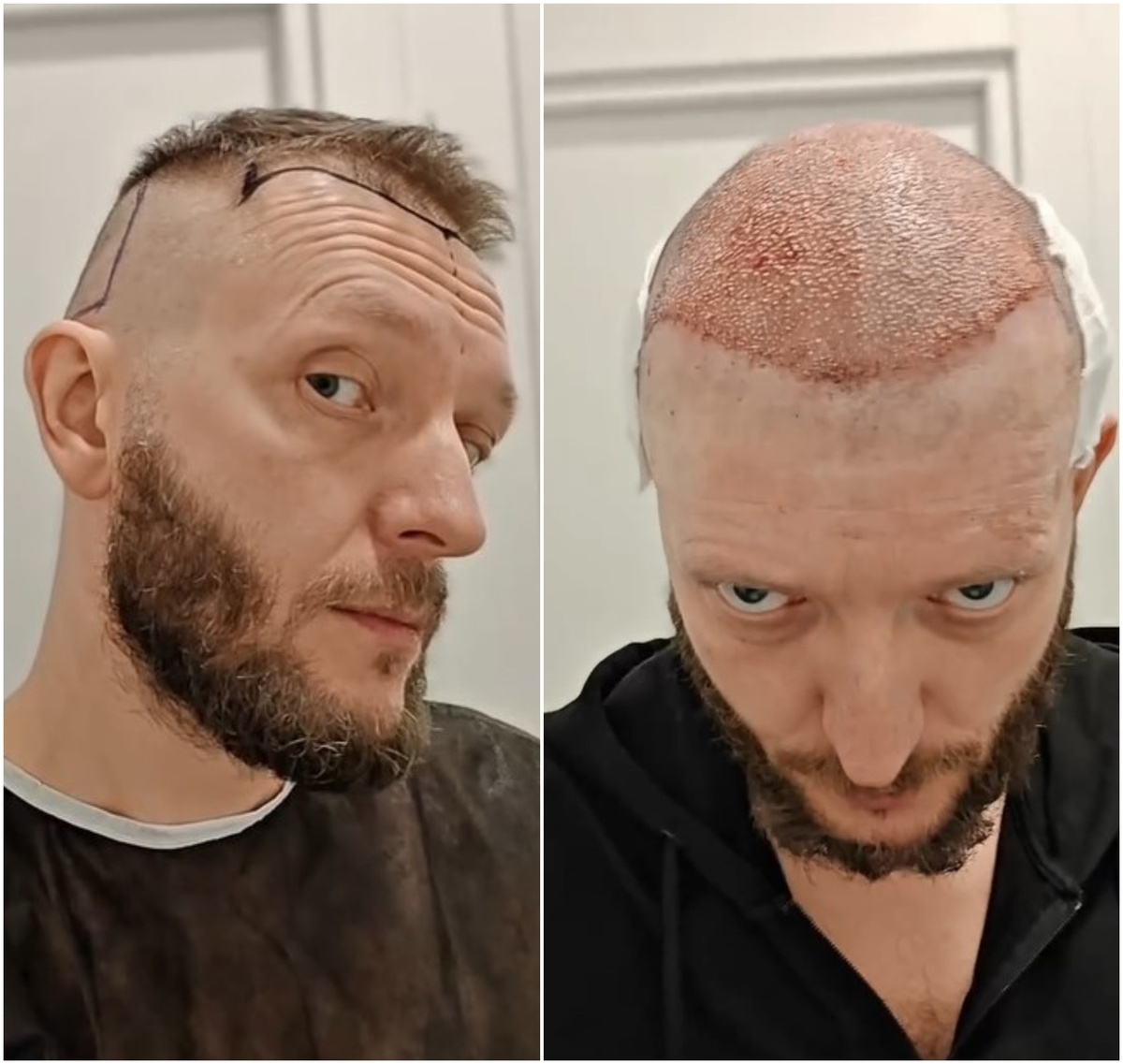    Константин Маласаев перед процедурой и послеКадры из видео