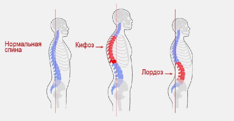 Кифоз — искривление позвоночника в районе грудного отдела.
